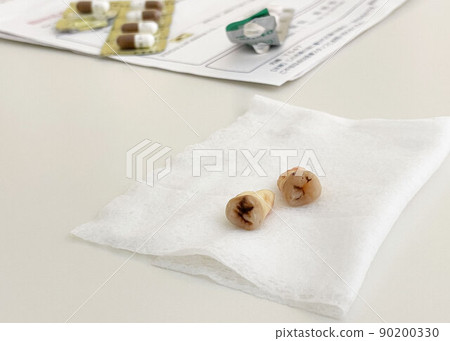 智齒拔牙_蛀牙2 智齒拔牙_蛀牙2 90200330