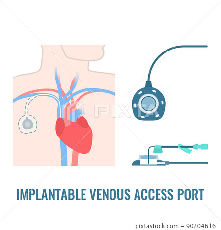 Implantable venous access port on male body Implantable venous access port on male body 90204616