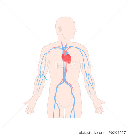 Peripherally inserted central catheter PICC on male body 90204627