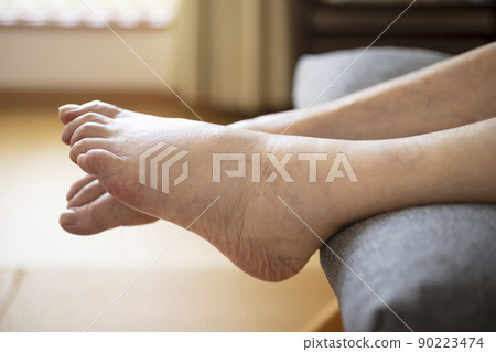 Swelling of the feet of the elderly 90223474