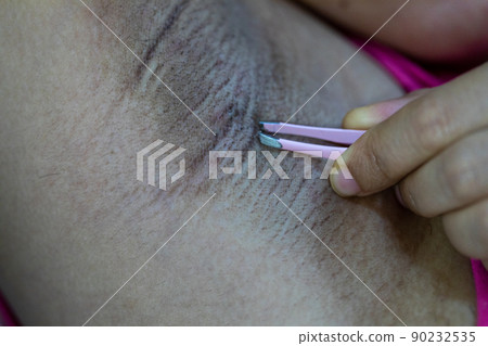 Scalp and hair follicles of human under the microscope in Lab. 90232535