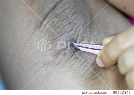 Scalp and hair follicles of human under the microscope in Lab. 90232541