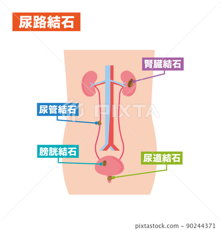 Illustrated illustration of urinary stones Illustrated illustration of urinary stones 90244371