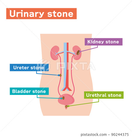 Illustrated illustration of urinary stones in English Illustrated illustration of urinary stones in English 90244375