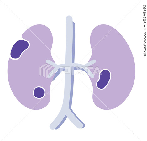 腎癌 腎癌 90248993