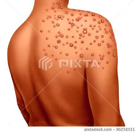 Pox Virus Disease 90258331
