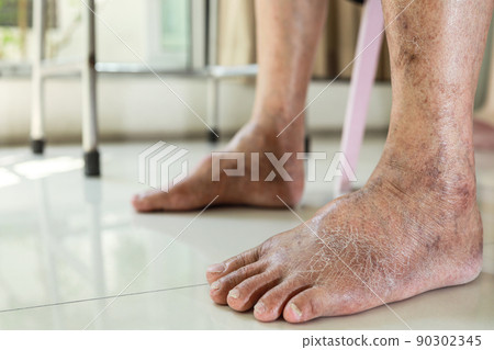 Closeup of foot,old elderly with swollen leg,dry skin of feet,cracks on the skin,lack of moisture,senior patient with beriberi,numbness of the toes,skin care problems,medical and health care concept Closeup of foot,old elderly with swollen leg,dry skin of feet,cracks on the skin,lack of moisture,senior patient with beriberi,numbness of the toes,skin care problems,medical and health care concept 90302345