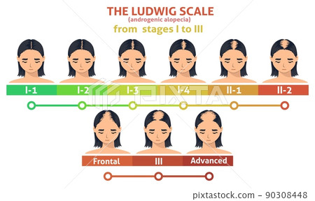 Ludwig scale of androgenic alopecia step poster 90308448