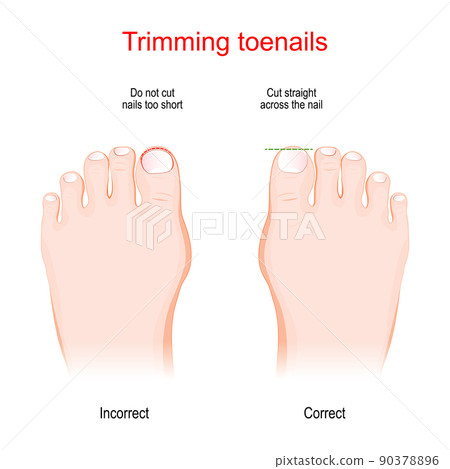Trimming toenails. Incorrect and Correct Trimming toenails. Incorrect and Correct 90378896