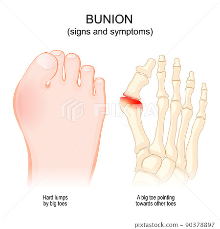 bunions. Hallux abducto valgus. bunions. Hallux abducto valgus. 90378897