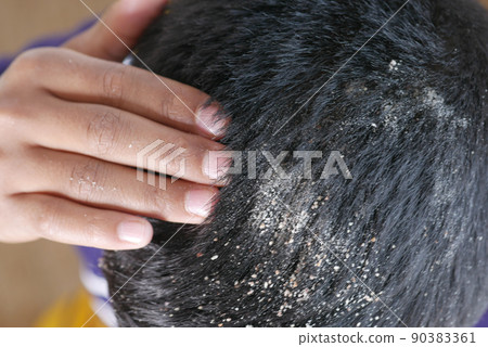 men with dandruff in his hair, closeup men with dandruff in his hair, closeup 90383361