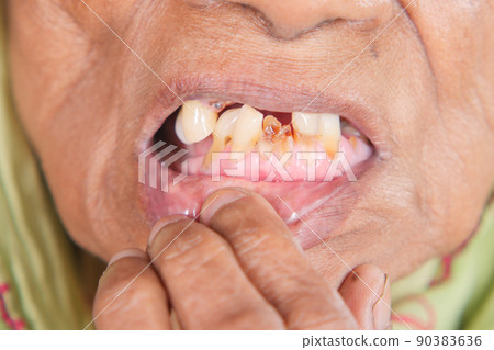 Senior Woman Smiling With Deformed Teeth Senior Woman Smiling With Deformed Teeth 90383636