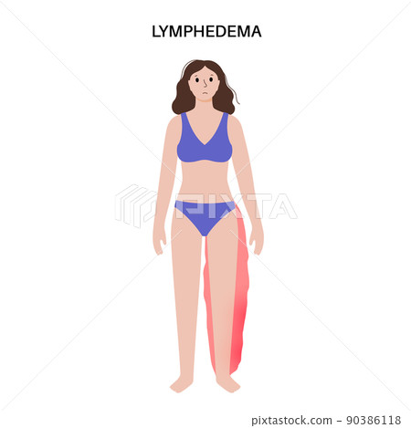 Lymphedema leg swelling Lymphedema leg swelling 90386118