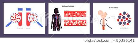 leukemia blood cancer 90386141