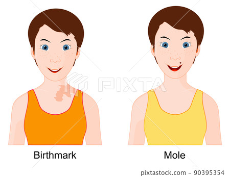 Mole and Birthmark. Comparison and difference Mole and Birthmark. Comparison and difference 90395354