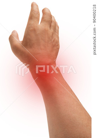 手腕腱鞘炎圖片 手腕腱鞘炎圖片 90400218