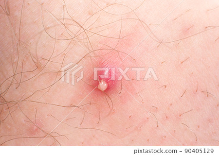 Macro photo of a large red pimple with the release of pus on human skin Macro photo of a large red pimple with the release of pus on human skin 90405129