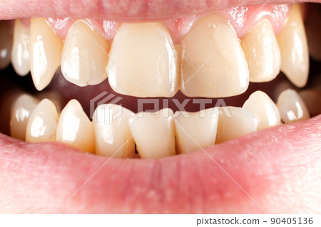 Teeth with tartar and caries, crooked lower foreground incisors, close-up Teeth with tartar and caries, crooked lower foreground incisors, close-up 90405136