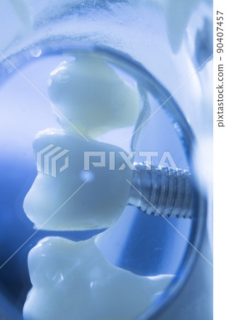 Dental tooth implant Dental tooth implant 90407457