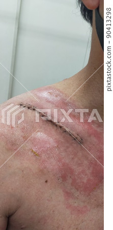 Clavicle fracture Clavicle fracture 90413298