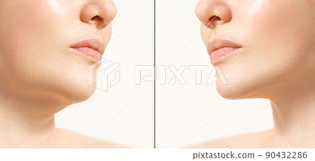 A close portrait of an aged woman before and after facial rejuvenation procedure. Correction of the chin shape liposuction of the neck. The result of the procedure in the clinic of aesthetic medicine. 90432286