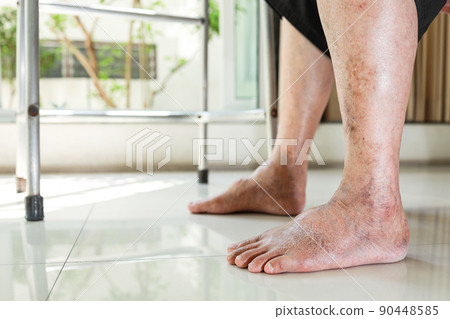 Closeup,Asian old senior with swollen feet,pain or numbness in the ankle,leg vein thrombosis,varicose veins problem,elderly people having diabetes,kidney or liver disease,edema or swelling in the feet Closeup,Asian old senior with swollen feet,pain or numbness in the ankle,leg vein thrombosis,varicose veins problem,elderly people having diabetes,kidney or liver disease,edema or swelling in the feet 90448585