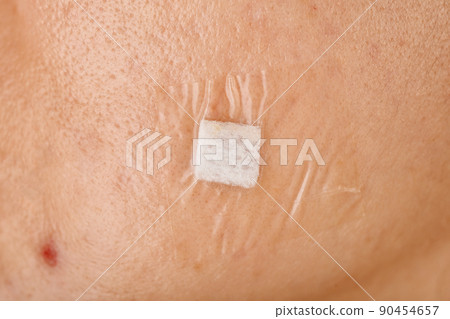 Wound care, Acne treatment, Facial scar wound dressing with sterile pad film. Wound care, Acne treatment, Facial scar wound dressing with sterile pad film. 90454657