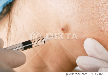 Cystic acne injection treatment, Facial skin problem, Acne disease in adult, Close up woman face Cystic acne injection treatment, Facial skin problem, Acne disease in adult, Close up woman face 90454658