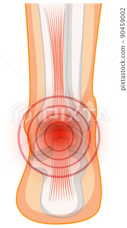 Achilles tendo rupture on white background 90459002