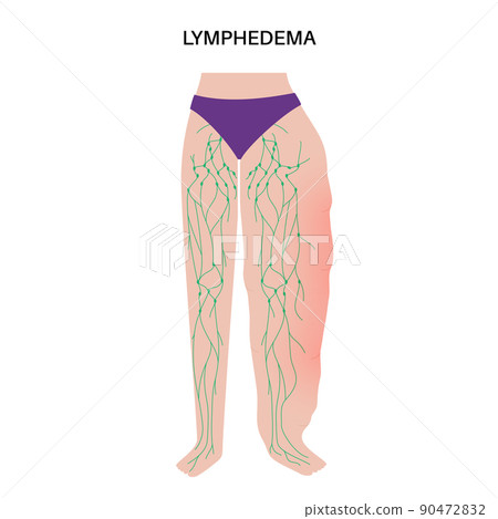 Lymphedema leg swelling Lymphedema leg swelling 90472832