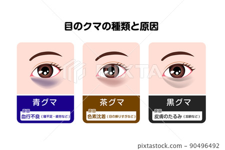 黑眼圈(眼熊)的類型和原因矢量圖解 黑眼圈(眼熊)的類型和原因矢量圖解 90496492