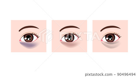 Kind of dark circles (eye bears) Vector illustration (without letters) 90496494