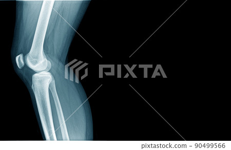 x-ray image og knee joint in blue tone x-ray image og knee joint in blue tone 90499566