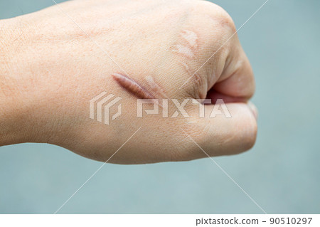 Keloid scar (Hypertrophic Scar) on man hand skin after accident 90510297