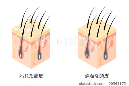 Illustrated illustration, isometric of cross section of dirty scalp and clean scalp 90563175