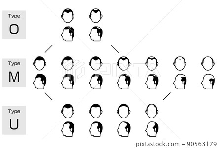 Illustration of each type of AGA androgenetic alopecia and progress stage Illustration of each type of AGA androgenetic alopecia and progress stage 90563179