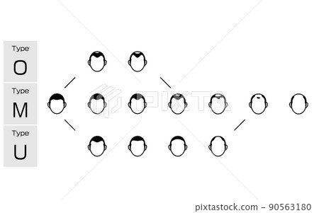 Illustration of each type of AGA androgenetic alopecia and progress stage Illustration of each type of AGA androgenetic alopecia and progress stage 90563180