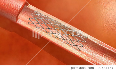 Hemoglobin cells flowing through a blocked Artery causing arteriosclerosis disease. 90584475