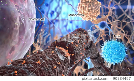 Multiple Myeloma, a type of cancer made up of a type of white blood cell called a plasma cell Multiple Myeloma, a type of cancer made up of a type of white blood cell called a plasma cell 90584497