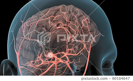 Cerebral hemorrhage as a result of an aneurysm bursting in the brain Cerebral hemorrhage as a result of an aneurysm bursting in the brain 90584647