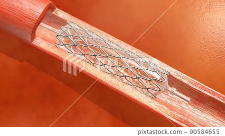 Hemoglobin cells flowing through a blocked Artery causing arteriosclerosis disease. 90584655