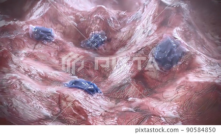 Joint space pannus. of Rheumatoid Arthritis. Joint space pannus. of Rheumatoid Arthritis. 90584850