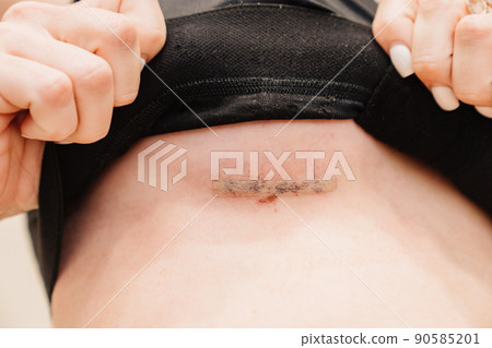 surgical sewing. A young woman in black compression underwear after mammoplasty. surgical sewing. A young woman in black compression underwear after mammoplasty. 90585201