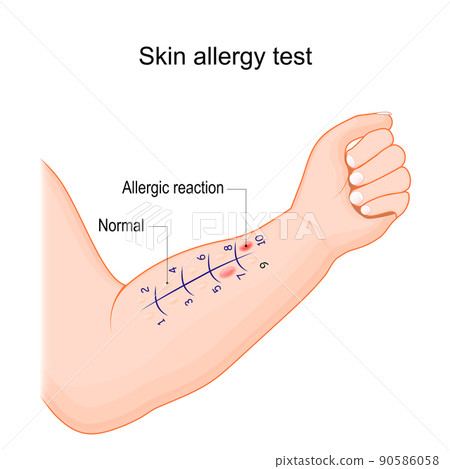 Skin allergy test. Human arm with allergen. 90586058