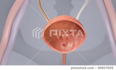 journey of kidney stone in human body journey of kidney stone in human body 90607609