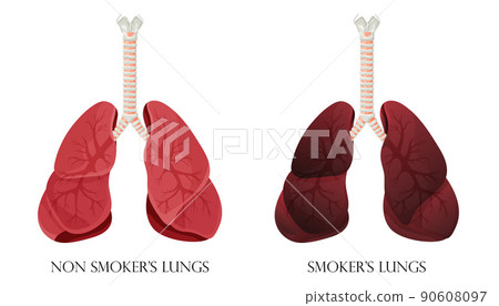 Illustration of normal healthy lungs and lungs smoker. Concept of stop smoking. Vector illustration. 90608097