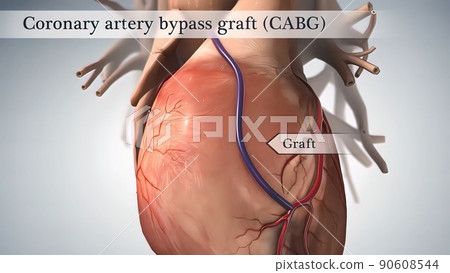 Coronary artery bypass surgery is done using a... - Stock Illustration ...