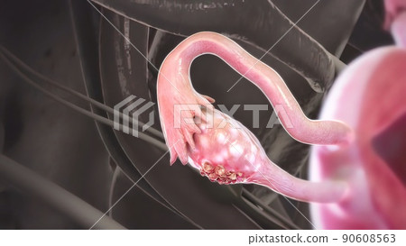 Ovarian cancer is a disease in which cells in the ovaries multiply and grow abnormally. Ovarian cancer is a disease in which cells in the ovaries multiply and grow abnormally. 90608563