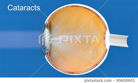 Cataract, clouding of the lens of the eye that causes decreased vision. 90608603
