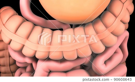 Colon during a enteroscopy with a intestinal or bowel cancer tumor visible. 90608643